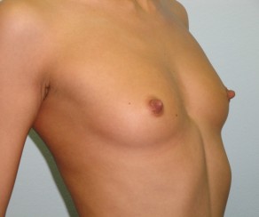 Augmentation - Brustvergrößerung 