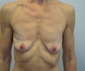 Augmentace a modelace prsou