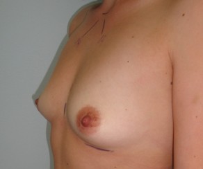Augmentation - Brustvergrößerung 