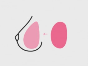 Výměna prsních implantátů